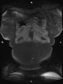File:Bilateral adrenal myelolipoma (Radiopaedia 63058-71537 Coronal T1 fat sat 101).jpg