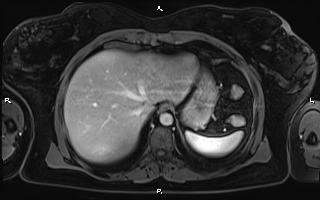 Bilateral adrenal myelolipoma (Radiopaedia 63058-71537 G 17).jpg