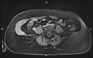 File:Bilateral adrenal myelolipoma (Radiopaedia 63058-71537 H 77).jpg