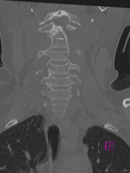 Bilateral atlanto-occipital assimilation (Radiopaedia 28350-28603 Coronal bone window 11).jpg