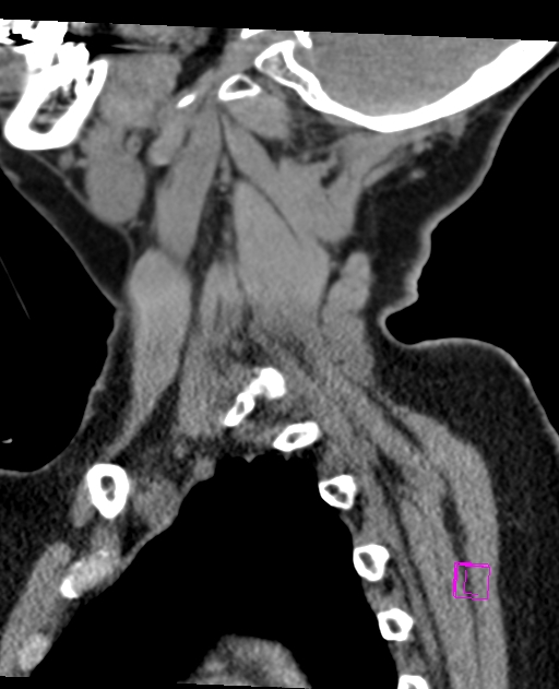 Bilateral atlanto-occipital assimilation (Radiopaedia 28350-28603 D 17).jpg