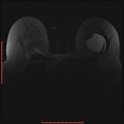 File:Bilateral breast implant rupture (Radiopaedia 24761-25027 PASTA Si 8).jpg