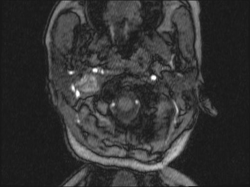 Bilateral carotid body tumors and right glomus jugulare tumor (Radiopaedia 20024-20060 Axial MRA 296).jpg