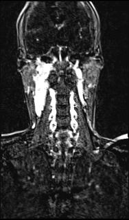 Bilateral carotid body tumors and right glomus jugulare tumor (Radiopaedia 20024-20060 MRA 111).jpg