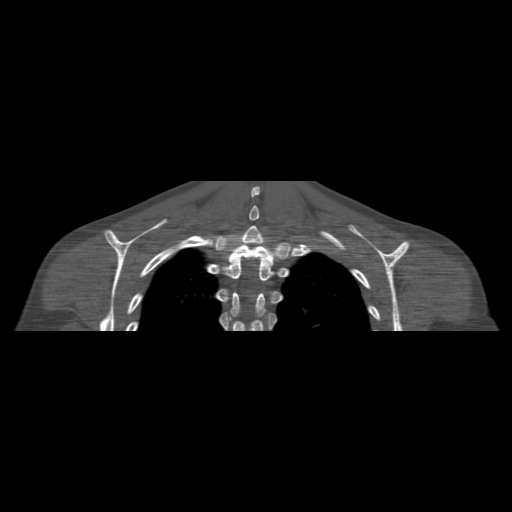 Bilateral chronic posterior shoulder dislocation (Radiopaedia 39213-41452 Coronal bone window 49).jpg