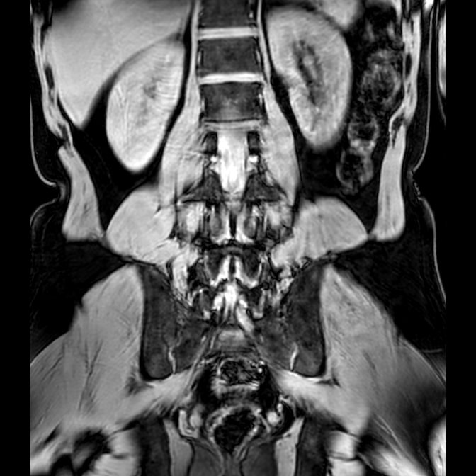 Bilateral conjoined nerve roots at different levels (Radiopaedia 73312-84063 Coronal WE 34).jpg