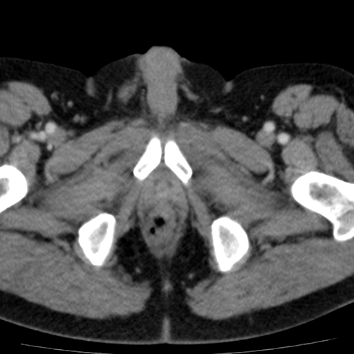 File:Bilateral direct inguinal herniae (Radiopaedia 17016-16719 B 27).jpg