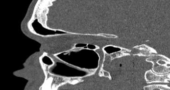 File:Bilateral ectopic infraorbital nerves (Radiopaedia 49006-54084 Sagittal 16).png