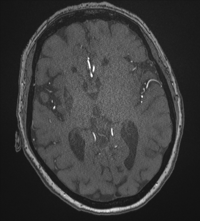 Bilateral fetal posterior communicating arteries (Radiopaedia 41286-44102 Axial MRA 113).png