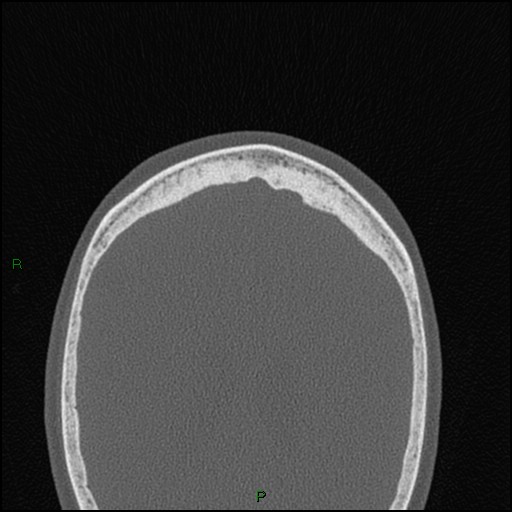 Bilateral frontal mucoceles (Radiopaedia 82352-96454 Axial bone window 26).jpg