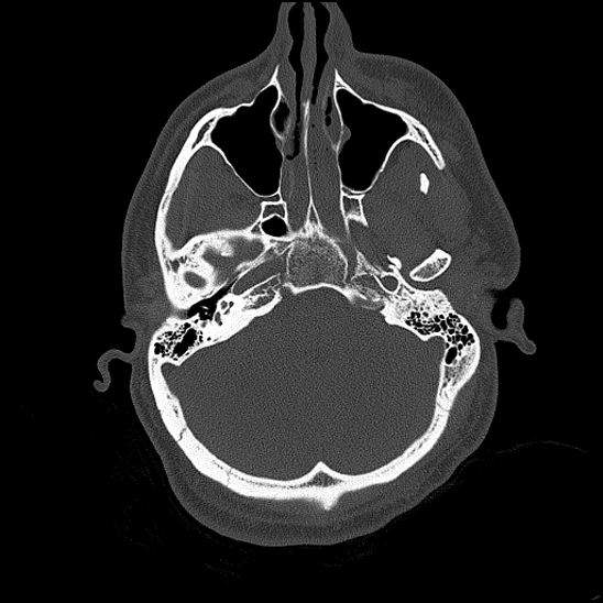 Bilateral occipital condyle fracture (type 2) (Radiopaedia 87675-104089 Axial bone thins 55).jpg