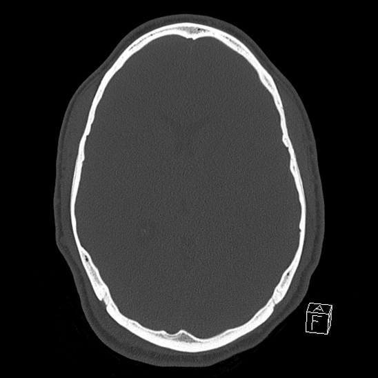 File:Bilateral occipital condyle fracture (type 2) (Radiopaedia 87675-104089 Axial bone window 72).jpg