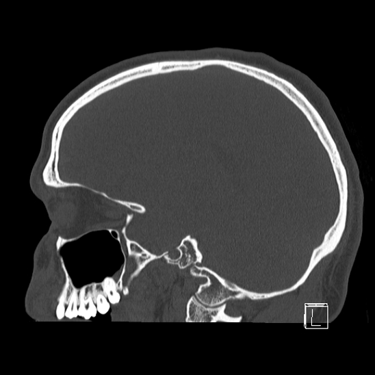 Bilateral occipital condyle fracture (type 2) (Radiopaedia 87675-104089 Sagittal bone window 36).jpg