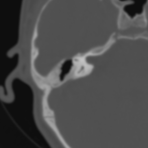 Bilateral otosclerosis (Radiopaedia 57237-64157 B 72).jpg