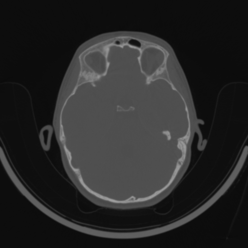 Bilateral otosclerosis (Radiopaedia 57237-64157 C 72).jpg
