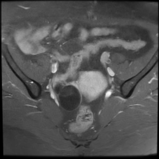 File:Bilateral ovarian dermoid cysts (Radiopaedia 90152-107338 Axial T1 C+ fat sat 8).jpg