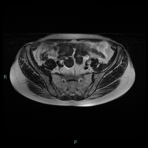 File:Bilateral ovarian fibroma (Radiopaedia 44568-48293 Axial T2 7).jpg