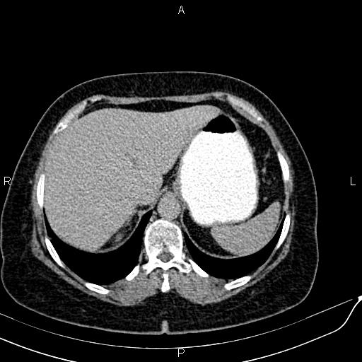 File:Bilateral ovarian serous cystadenocarcinoma (Radiopaedia 86062-101989 Axial C+ delayed 5).jpg