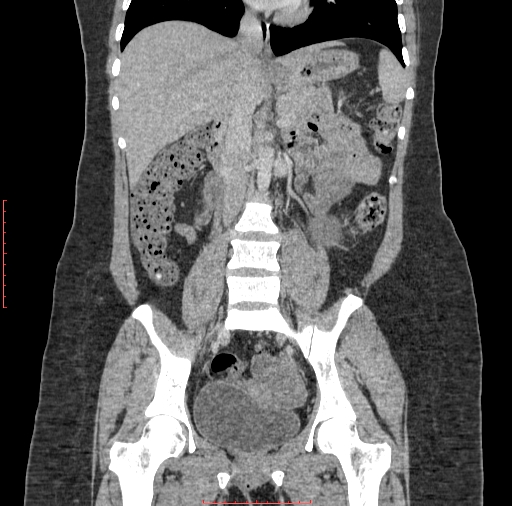 File:Bilateral ovarian serous cystadenocarcinoma with right ovarian torsion (Radiopaedia 32640-33611 B 21).jpg