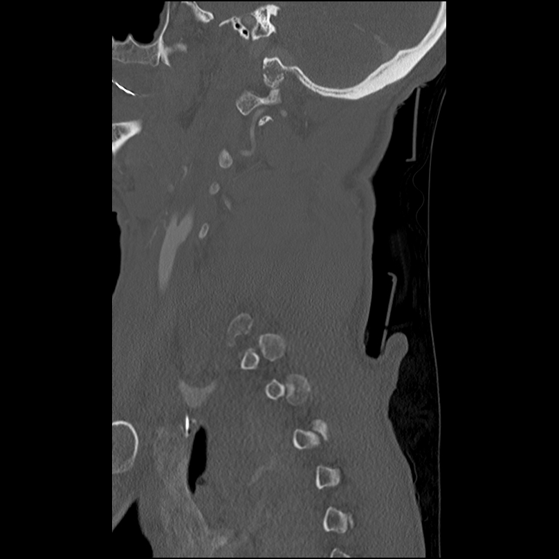 Bilateral perched facets with cord injury (Radiopaedia 45587-49713 Sagittal bone window 10).jpg