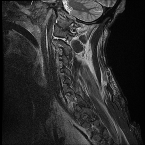 File:Bilateral perched facets with cord injury (Radiopaedia 45587-49714 Sagittal STIR 14).jpg