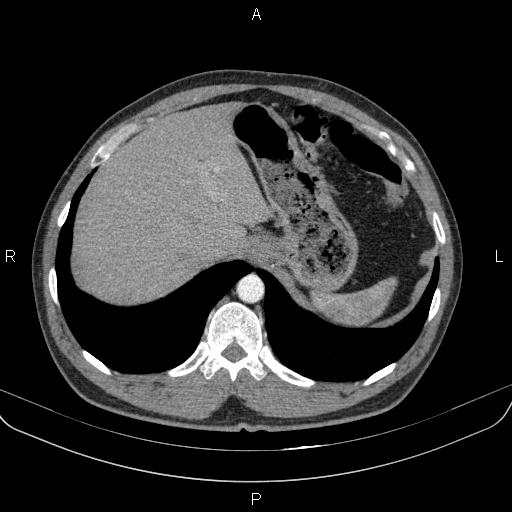 Bilateral pulmonary AVM (Radiopaedia 83134-97505 A 66).jpg