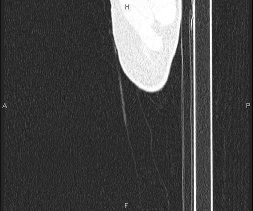 Bilateral pulmonary AVM (Radiopaedia 83134-97505 Sagittal lung window 121).jpg