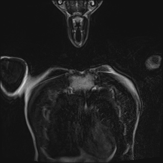 Bilateral spinoglenoid notch ganglion cysts (Radiopaedia 29577-30082 Coronal T2 14).jpg