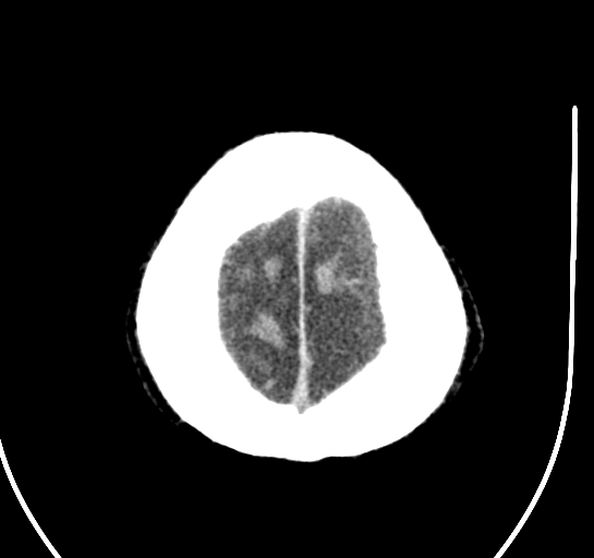 Bilateral subdural hygroma (Radiopaedia 73637-84421 Axial 4).jpg