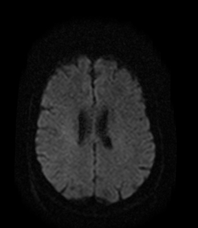 File:Bilateral thalamic glioma (Radiopaedia 65852-75009 Axial DWI 14).jpg