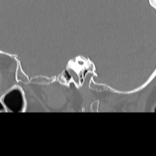Bilateral tympanoplasty (Radiopaedia 16947-16664 Sagittal bone window 51).jpg
