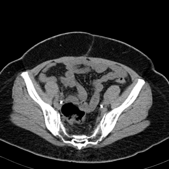 Bilateral ureteric stents (Radiopaedia 48795-53825 Axial non-contrast 51).jpg