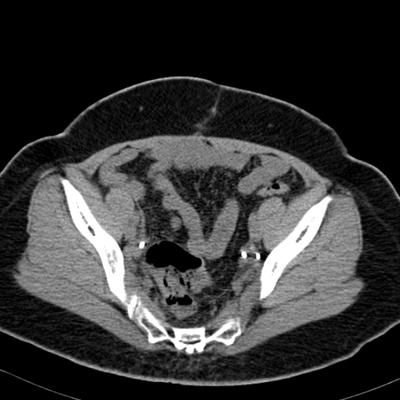 Bilateral ureteric stents (Radiopaedia 48795-53825 Axial non-contrast 53).jpg