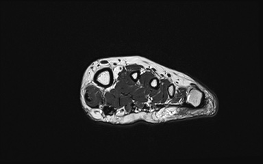 Bipartite hallux sesamoid diastasis (Radiopaedia 77133-89109 Coronal PD 21).jpg
