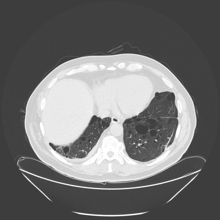 Birt-Hogg-Dubé syndrome (Radiopaedia 52578-58491 Axial lung window 48).jpg