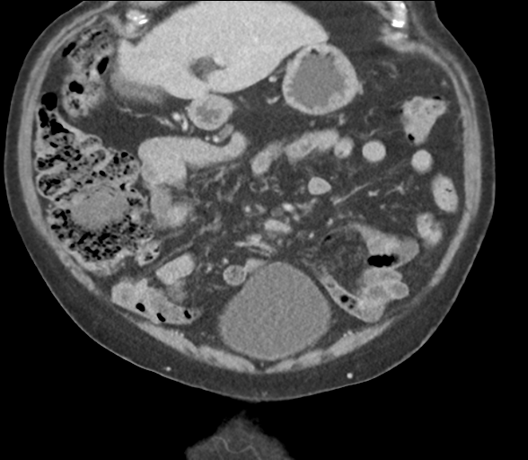 File:Bladder papillary urothelial carcinoma (Radiopaedia 48119-52951 C 22).png