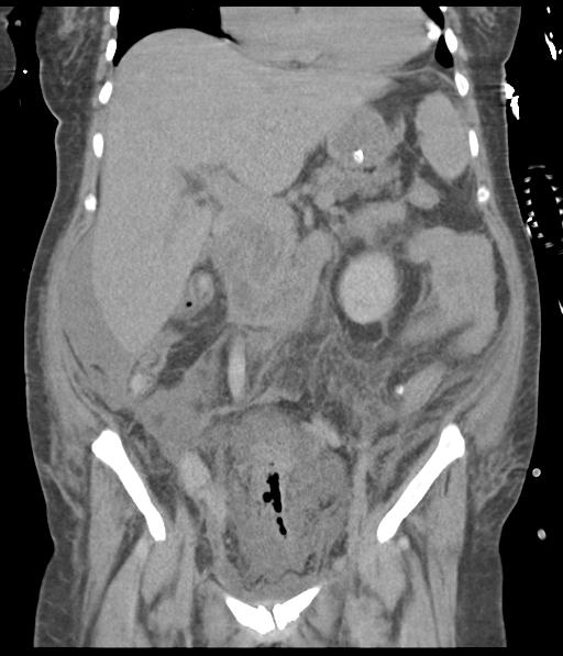 File:Bladder rupture post renal biopsy (Radiopaedia 30863-31572 Coronal non-contrast 28).jpg