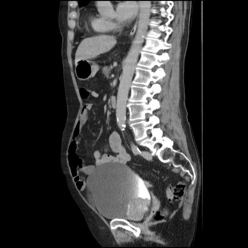 Bladder tumor detected on trauma CT (Radiopaedia 51809-57609 E 33).jpg