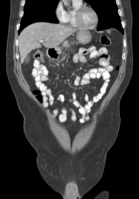 Bleeding duodenal ulcer and adenomyomatosis of gallbladder (Radiopaedia 61834-69861 B 62).jpg