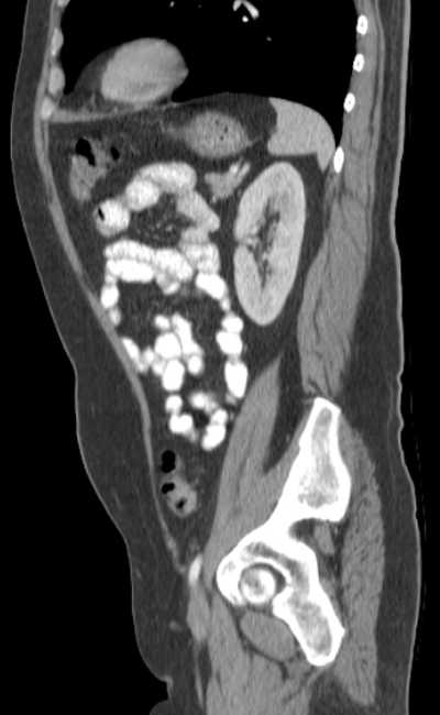 Bleeding duodenal ulcer and adenomyomatosis of gallbladder (Radiopaedia 61834-69861 C 73).jpg
