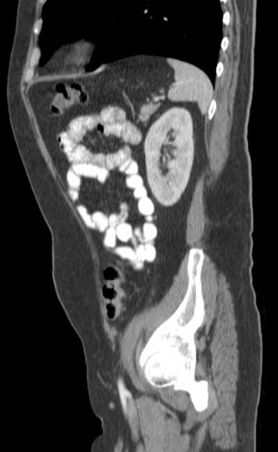 Bleeding duodenal ulcer and adenomyomatosis of gallbladder (Radiopaedia 61834-69861 C 77).jpg