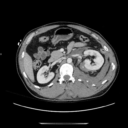 Blunt abdominal trauma with solid organ and musculoskelatal injury with active extravasation (Radiopaedia 68364-77895 A 57).jpg