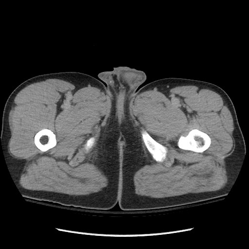 File:Blunt abdominal trauma with solid organ and musculoskelatal injury with active extravasation (Radiopaedia 68364-77895 Axial C+ delayed 155).jpg