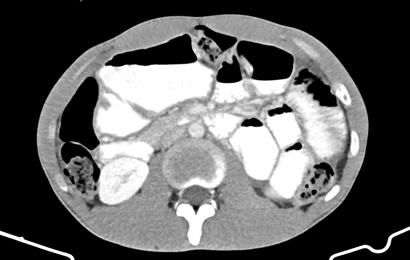 Blunt injury to the small bowel (Radiopaedia 74953-85987 A 71).jpg