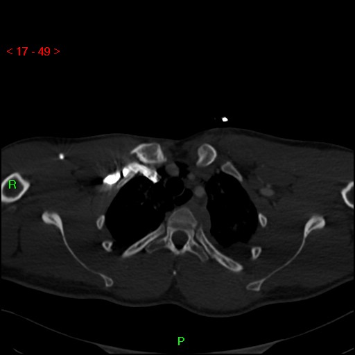 Blunt thoracic trauma (Radiopaedia 73454-84221 Axial bone window 19).jpg