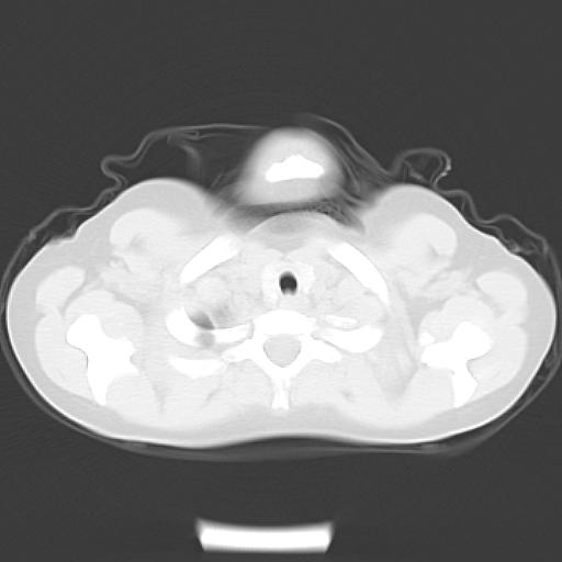 File:Bochdalek diaphragmatic hernia (Radiopaedia 38866-41059 Axial lung window 2).jpg