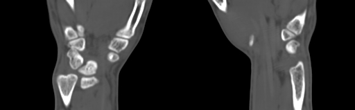 File:Bone islands - carpus (Radiopaedia 63141-71658 Coronal bone window 54).jpg