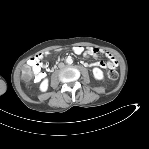 Bone metastasis from squamous cell carcinoma (Radiopaedia 30133-30730 B 39).jpg