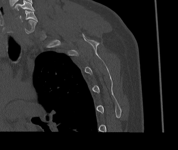 Bony Bankart and Hill-Sachs lesions (Radiopaedia 33622-34727 Sagittal bone window 66).png