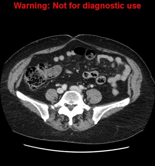 File:Bosniak renal cyst - type II (Radiopaedia 23404-23468 D 47).jpg